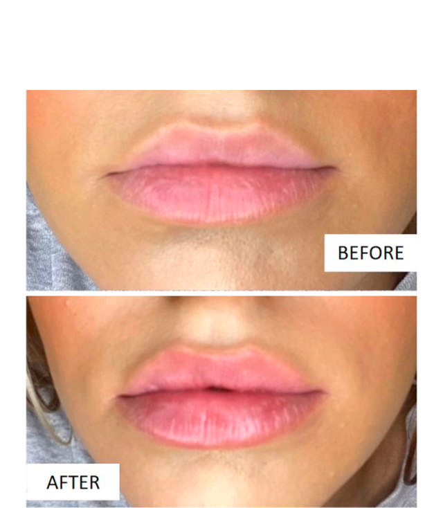 Plump It No Needles Lip Filler Kit (Volumising + Hyaluronic plumpers)